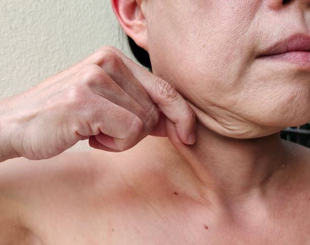 how to get rid of turkey neck