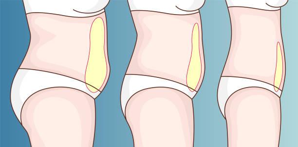 Can visceral fat be surgically removed?
